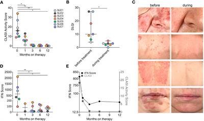 Frontiers Case Report Response Of Cutaneous Lupus Lesions In SLE To